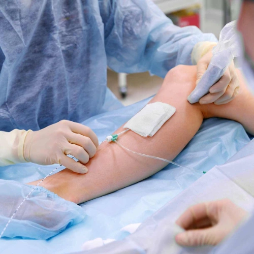 Varicose Veins 4 Endovenous Laser Ablation (EVLA)