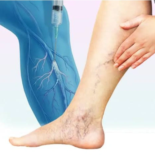 Varicose Veins 7 Foam Sclerotherapy