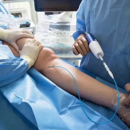 Varicose Veins 6 Medical Glue Injection