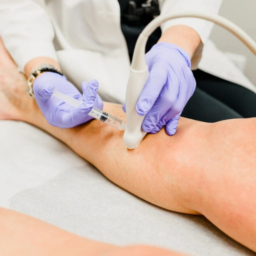 Varicose Veins 5 Radiofrequency Ablation (RFA)