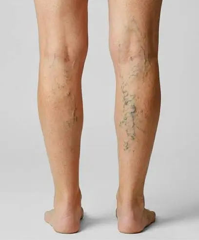Varicose veins symptoms