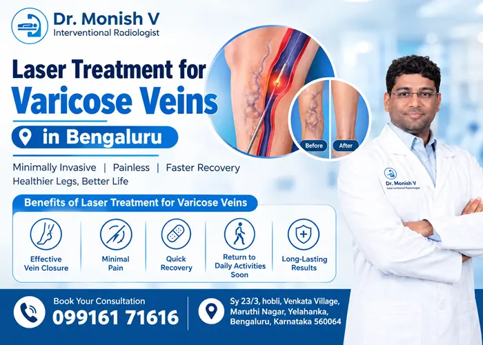 Laser Treatment for Varicose Veins in Bengaluru